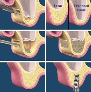 Sinus Lift Surgery Tampa & Wesley Chapel .